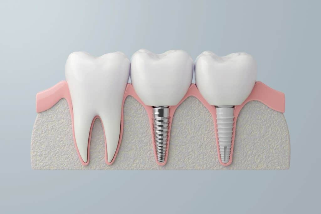 Full-Arch Dental Implants Portland