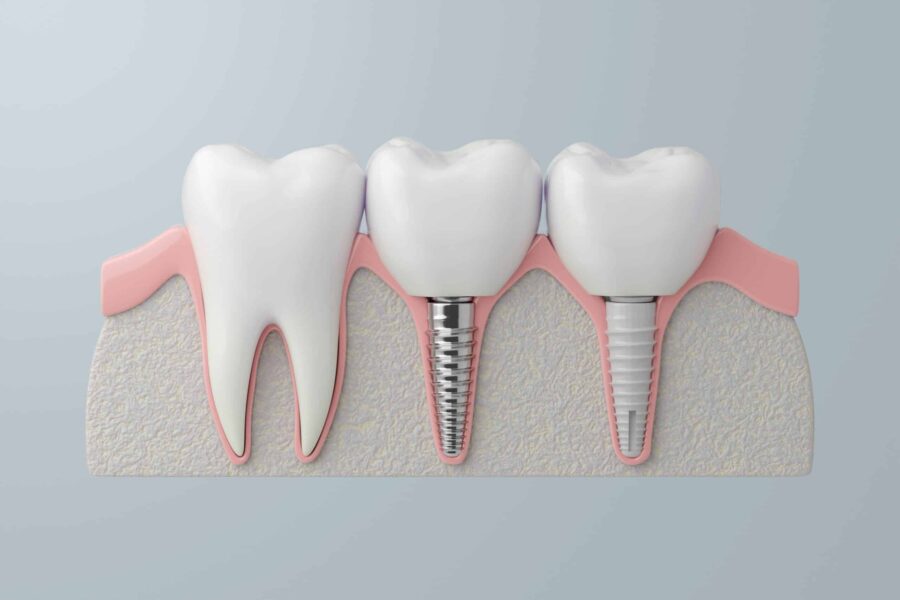 Full-Arch Dental Implants Portland