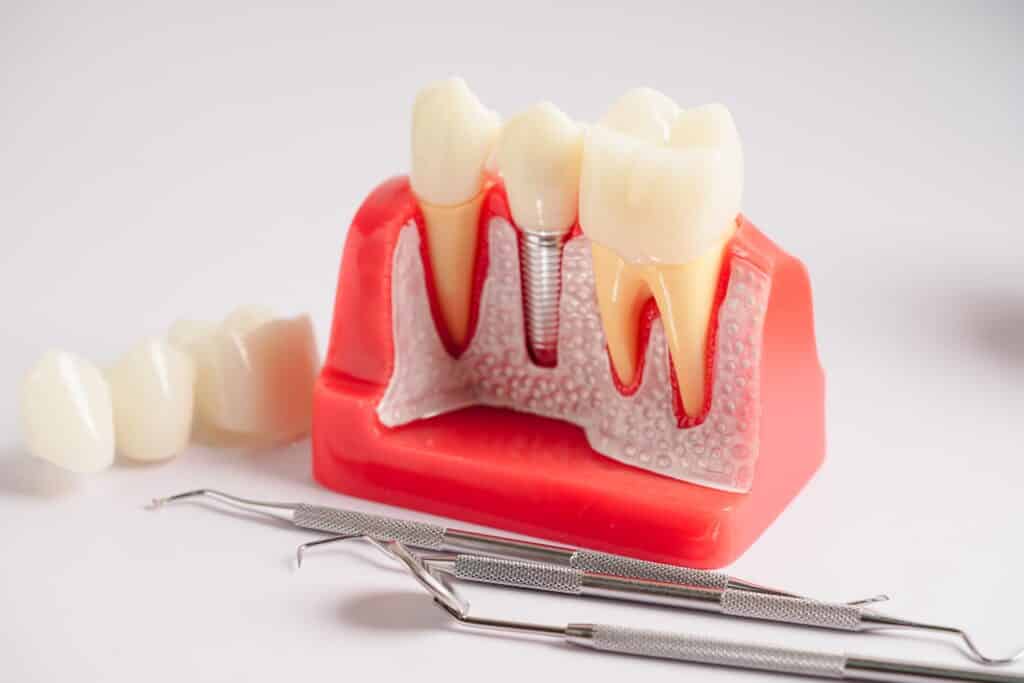 Implant-Supported Dentures Portland